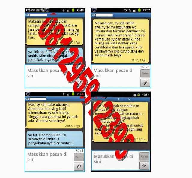 Cara pengobatan Kutil di kelamin yang aman Cara pengobatan Kutil di kelamin yang aman