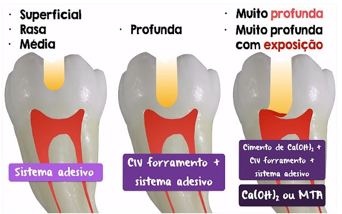 DENTÍSTICA: Proteção do Complexo Dentinopulpar - Profundidade Cavitária