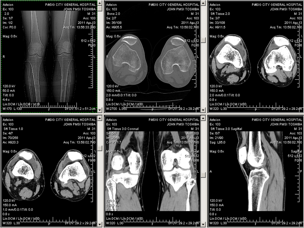 Familia Villanueva CT Scan images of my injured knee...