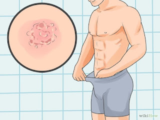 Obat Penyakit Sifilis Untuk Pria Yang Terbaik Obat Penyakit Sifilis Untuk Pria Yang Terbaik