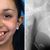 UMA CIRURGIA NO QUEIXO MUDOU COMPLETAMENTE A VIDA DESSA GAROTA, VEJA O RESULTADO