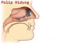 Polip Hidung Cara Menangani Polip Hidung
