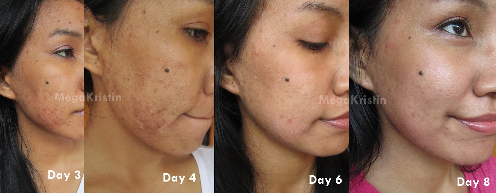 Jessner Peel Facial Experience Mega Kristin