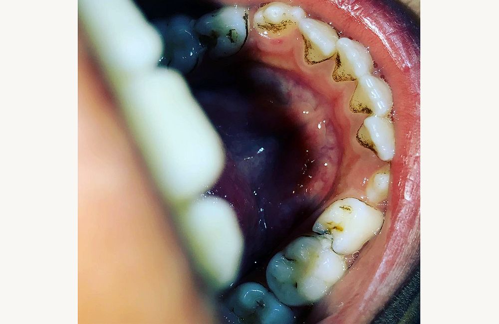 Dentes de Leite