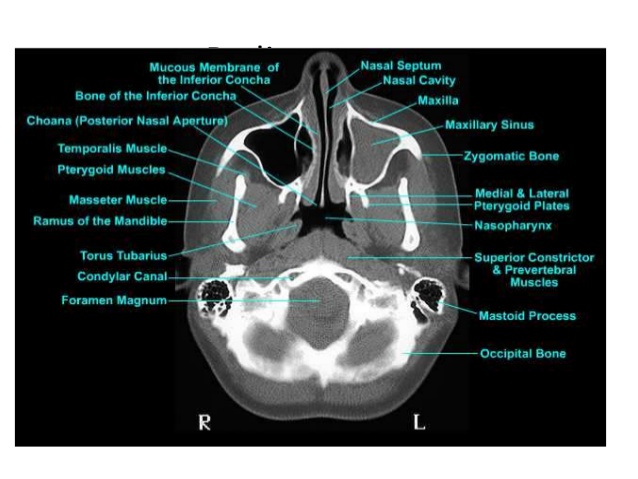 Radiologist For Ever: Parapharyngeal space rule 1:Anatomy and pathology