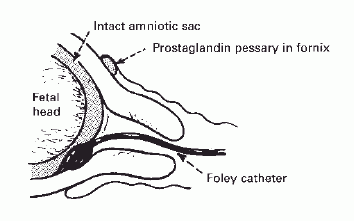 ob gyn updated misoprostol in combination with transcervical foley foley bulb