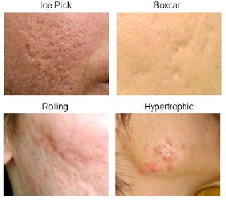 cicatrices del acné