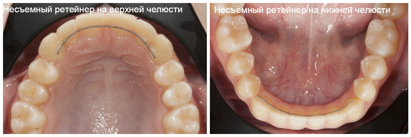 Капа ортодонтическая ретенционная. Капа при бруксизме
