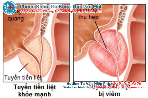 Viêm tuyến tiền liệt có quan hệ được hay không?