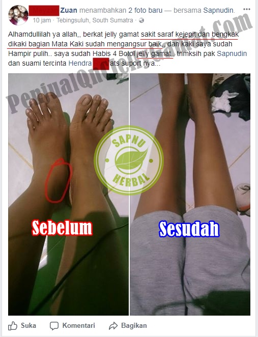 Cara Mengobati Syaraf Kejepit Di Leher Secara Alami Terbukti Mujarab ~ TESTIMONI QNC JELLY GAMAT Cara Mengobati Syaraf Kejepit Di Leher Secara Alami Terbukti Mujarab ~ TESTIMONI QNC JELLY GAMAT