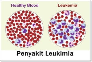 Definisi Leukimia