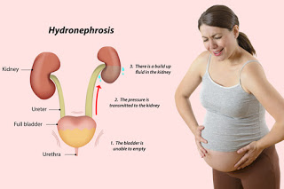 Hydronephrosis, Causes, Symptoms, Diagnosis, Complication and Homeopathy treatment 