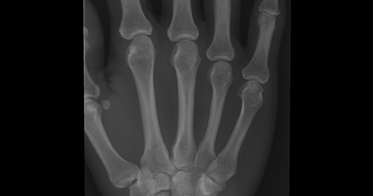 Daily dose negative ulnar variance