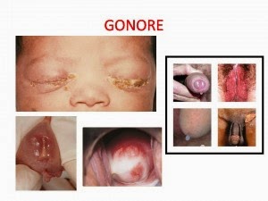 obat tradisional menyembuhkan gonore, obat gonore atau kencing nanah, Obat Gonore alami