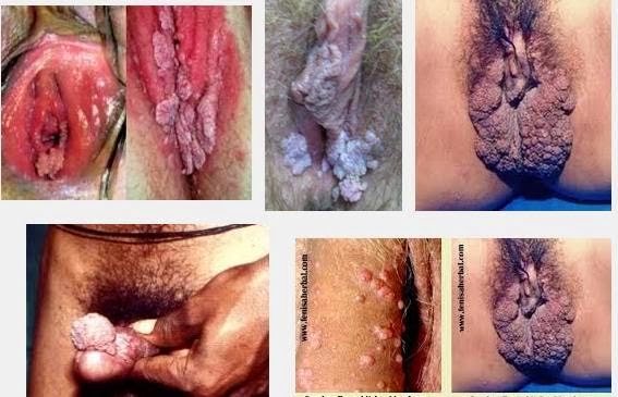 Obat Daging Tumbuh-Benjolan Disekitar Vagina