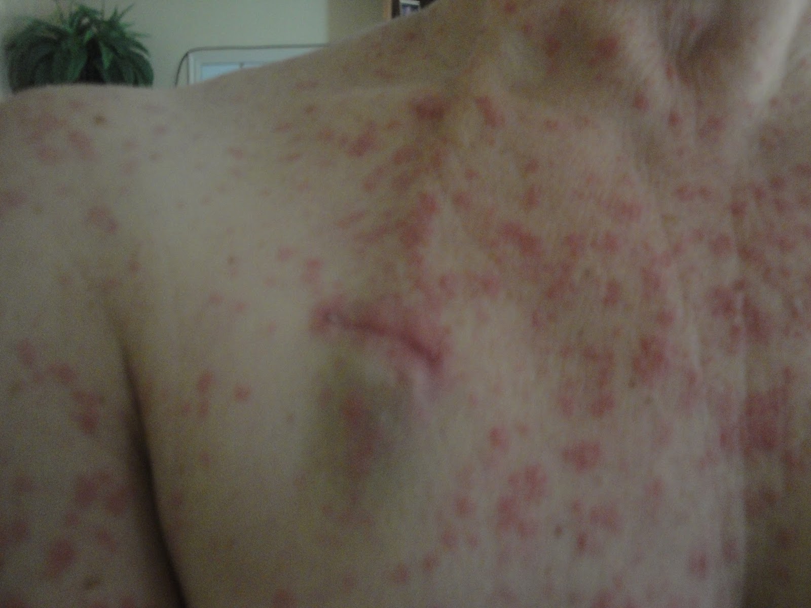 The Road I Travel: Hives from my chemo and the port in my collar bone