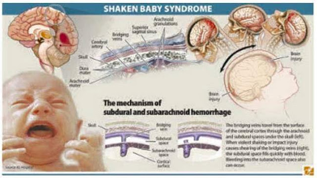 shaken baby syndrome essays The paper is on shaken baby syndrome (also known as abusive head trauma) use as many sources as you need, 2 being the minimum admission essays. shaken baby syndrome essays The paper is on shaken baby syndrome (also known as abusive head trauma) use as many sources as you need, 2 being the minimum admission essays.