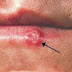 Symptoms of genital herpes you should know to prevent further complication