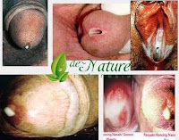 Obat Sipilis ampuh Dan paling Laris Saat ini Obat Sipilis ampuh Dan paling Laris Saat ini