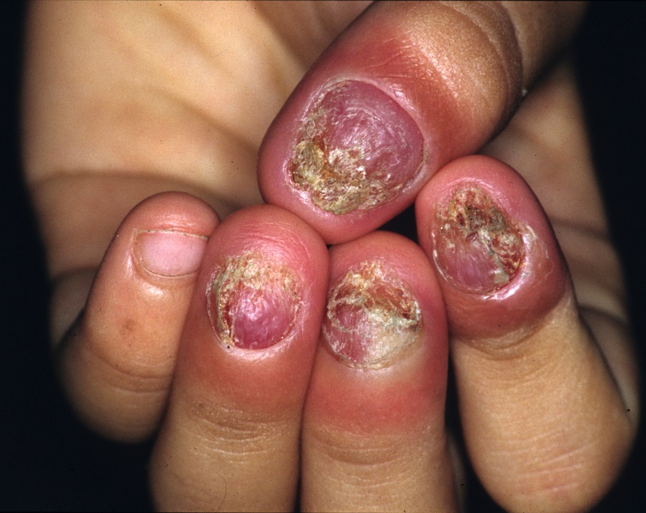 infection under fingernail