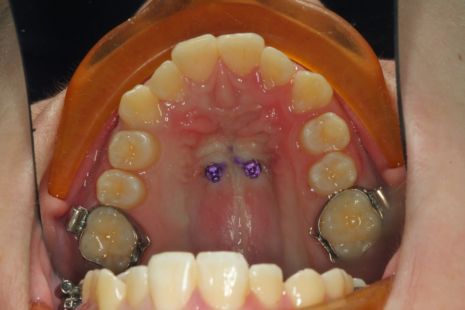 Orthodontic Thoughts May 2015