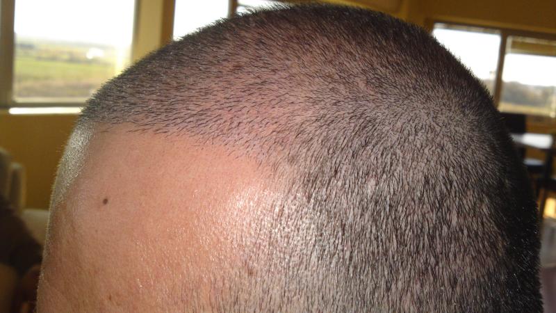 How common is shock loss after hair transplant what you can do to avoid ...