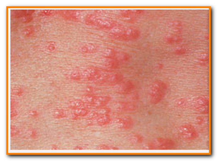 CDC - Scabies - General Information - Frequently Asked ...