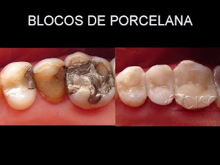 ondotologico  Plano Odontológico com Prótese amil dental rede credenciada convenio odontologico   #PlanoOdontológicocomPrótese  #planoondotologico