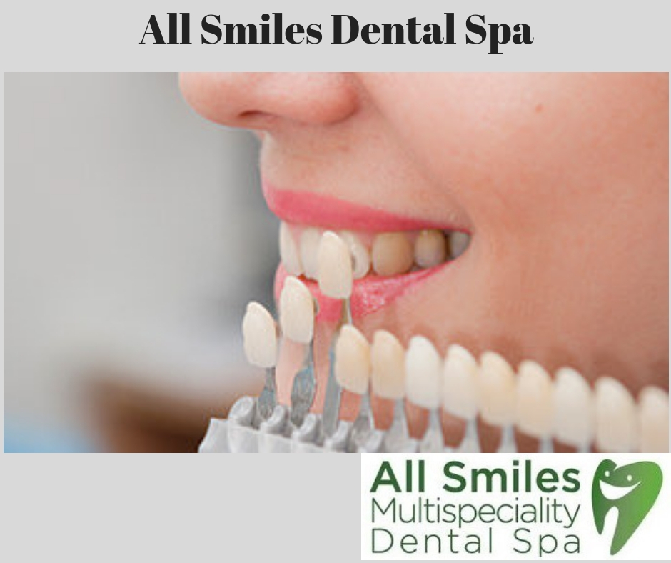 Veneers Dubai All Smiles Dental Spa At Your Service