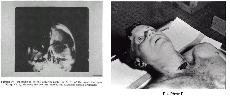 JFK-Autopsy-Pictures.jpg
