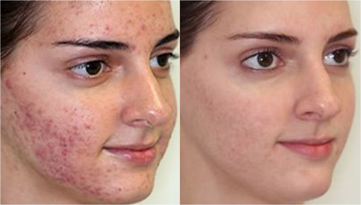 Dra. Elizabeth Cabanillas TRATAMIENTO ANTIACNEICO CON IPL