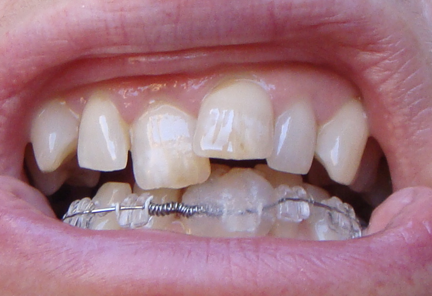 Braces at 56 Incognito Brace Off Today!! Fixed Retainer Fitted