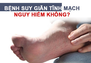 Bệnh giãn tĩnh mạch có nguy hiểm không?