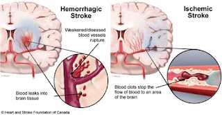 Pengobatan Pasca Stroke, Stroke Di Indonesia Depkes, Pengobatan Khusus Stroke, Penyakit Silent Stroke, Pengobatan Alami Gejala Stroke, Apakah Penyakit Stroke Bisa Diobati, Obat Untuk Stroke Perdarahan, Mengobati Stroke Alami, Obat Stroke Kulit Manggis, Obat Penyakit Stroke, Penyakit Stroke Gejala, Cara Mengobati Stroke Secara Tradisional, Pengobatan Alternatif Stroke Di Jakarta Timur, Pengobatan Pasca Stroke, Obat Stroke Buatan Sendiri, Obat Stroke Tak Bisa Bicara, Obat Stroke Pdf, Pengobatan Penyakit Stroke Secara Tradisional, Ciriciri Penyakit Stroke, Mengobati Stroke Secara Tradisional, Diagnosis Penyakit Stroke Pdf, Obat Stroke Otarev, Obat Tradisional Pencegah Stroke, Penyakit Stroke Doc, Ubat Penyakit Stroke, Cara Mengobati Stroke Dengan Bekam, Obat Herbal Mengobati Stroke, Mengobati Stroke Tanpa Obat, Obat Stroke Pendarahan, Cara Mengobati Penyakit Stroke Dan Darah Tinggi  