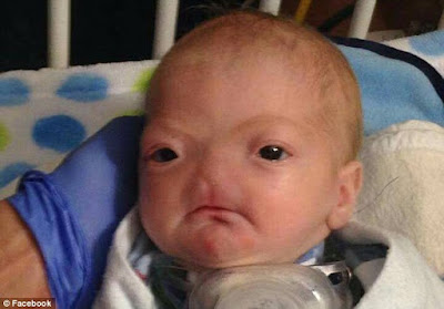Bayi Ajaib Yang Lahir Dengan Kondisi Langka di Dunia Bayi Ajaib Yang Lahir Dengan Kondisi Langka di Dunia