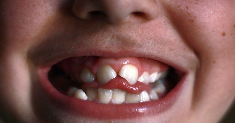 Orthodontic Tongue Thrusting Habit A Review Odontobebe