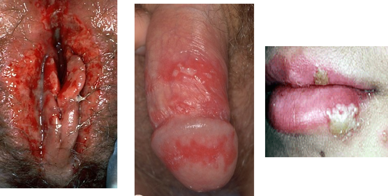 Slideshow: Pictures and Facts About STDs - WebMD