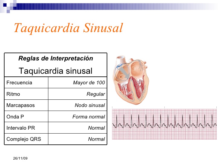 FUNDAMENTOS DE ELECTROCARDIOGRAFIA ARRITMIA CARDIACAS COMUNES