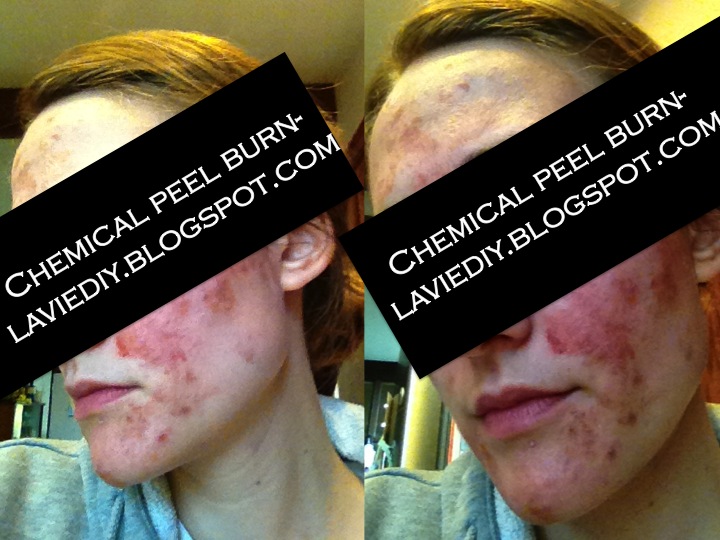 chemical peel burn