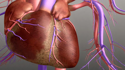 Atrial Fibrillation Κολπική μαρμαρυγή