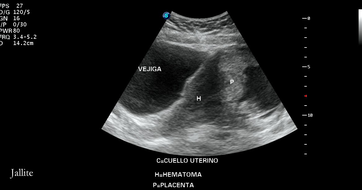 Placenta Previa & Hematoma Retroplacentario