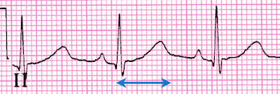 neurontin qt prolongation