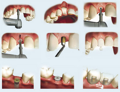 Cấy ghép răng với Implant giá bao nhiêu ?