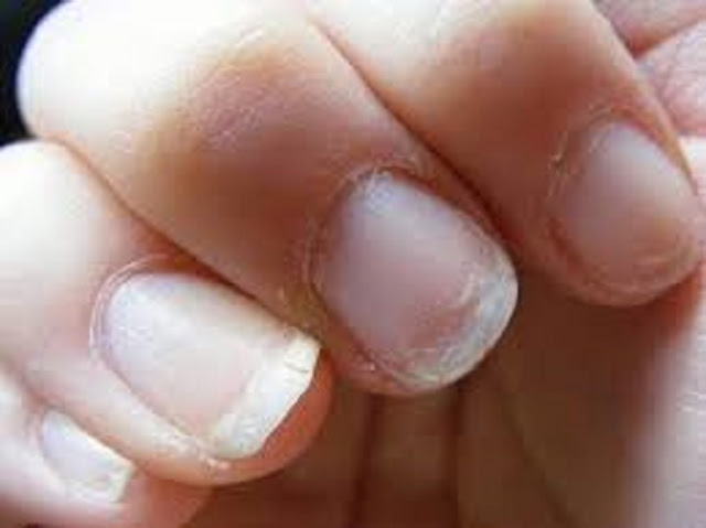 ATENCIÓN: ¡SI USTED VE ESTO EN SUS UÑAS, CONSULTE A SU DOCTOR INMEDIATAMENTE! ATENCIÓN: ¡SI USTED VE ESTO EN SUS UÑAS, CONSULTE A SU DOCTOR INMEDIATAMENTE!