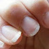 ATENCIÓN: ¡SI USTED VE ESTO EN SUS UÑAS, CONSULTE A SU DOCTOR INMEDIATAMENTE!