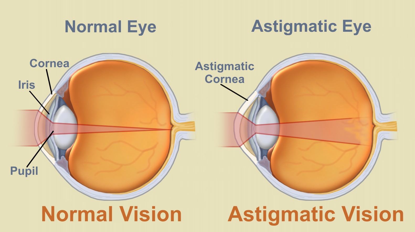 Can An Astigmatism Slow Down A Baby’s Development?