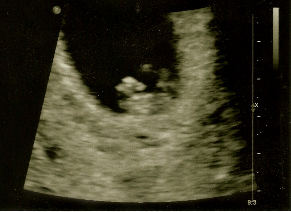 Bump On The Hill Ultrasound and Heartbeat!