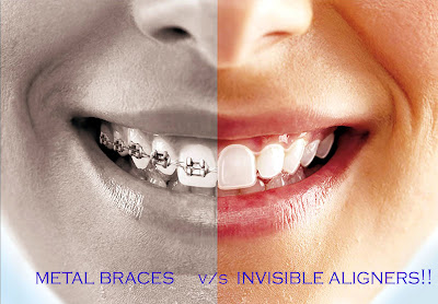 Invisible Braces