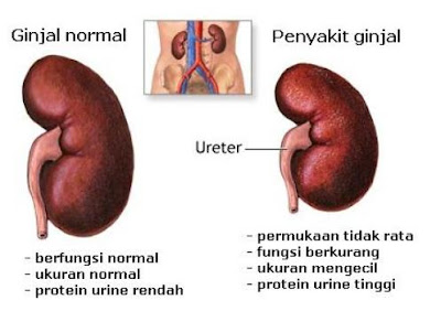 Waspada Asam Urat Yang Tinggi Waspada Asam Urat Yang Tinggi