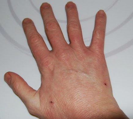 Very Mild Case? - Dermatitis Herpetiformis - Celiac.com ...